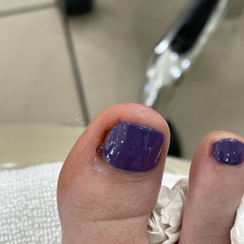 Jbella Nails - Bloody toe from aggressive cuticle cutting - Nail Salons Near Me - Aptos, California
