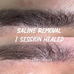 Brow Cafe - Stuck with old Microblading you hate? Start over with saline tattoo removal in 2026!