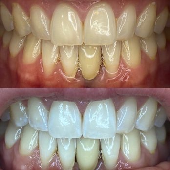 We Whiten - Teeth Whitening Near Me - Murray, Utah