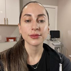 Younger World Med Spa - Little swollen but the after!