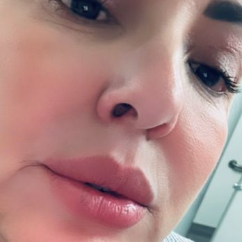 Bella Aesthetics - March 2025 Lip filler with Rhonda - Cosmetics & Beauty Supply Near Me - Rancho Cucamonga, California
