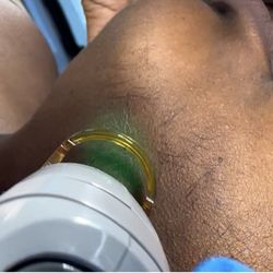 Laser Queen Beauty Studio - Candela GentleMax Pro Laser Hair Removal for Dark Skin. Safe facial hair removal in Hallandale Beach. Book your appointment today!