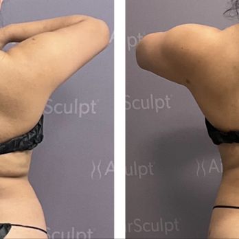 AirSculpt - Orange County - Body Contouring Near Me - Irvine, California AirSculpt - Orange County - Body Contouring Near Me - Irvine, California