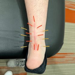 Isaac Carlson, DC - Dry Needling treatment