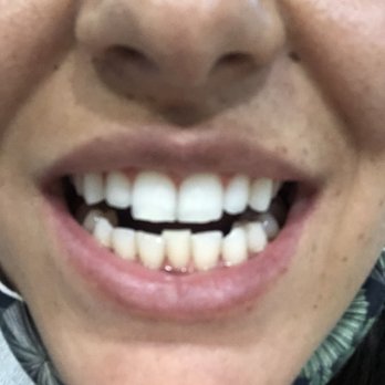 Fillmore Dental Spa - Before Shaving Open - General Dentistry Near Me - San Francisco, California