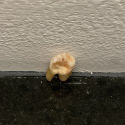 J. Scott Anderson, DDS - The Gentle Art of Dentistry - This is how badly that tooth was decayed - and I had no idea it was even there! The decay was right above the root pulp of two roots.