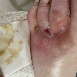 Aviata - Example of lack of care. 3 days without a bandage change. This was just a scratch when first admitted.