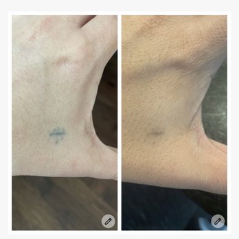 LaserAway - The first photo is from my consultation. They recommended 3 treatments. The second photo is 10 days after my 3rd treatment. - Laser Hair Removal Near Me - Las Vegas, Nevada