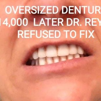 Affordable Dentures & Implants - This is what a new denture from Dr. Reyes looks like. Awful  Clear choice dental is correcting his mistakes he's not qualified - General Dentistry Near Me - Chantilly, Virginia