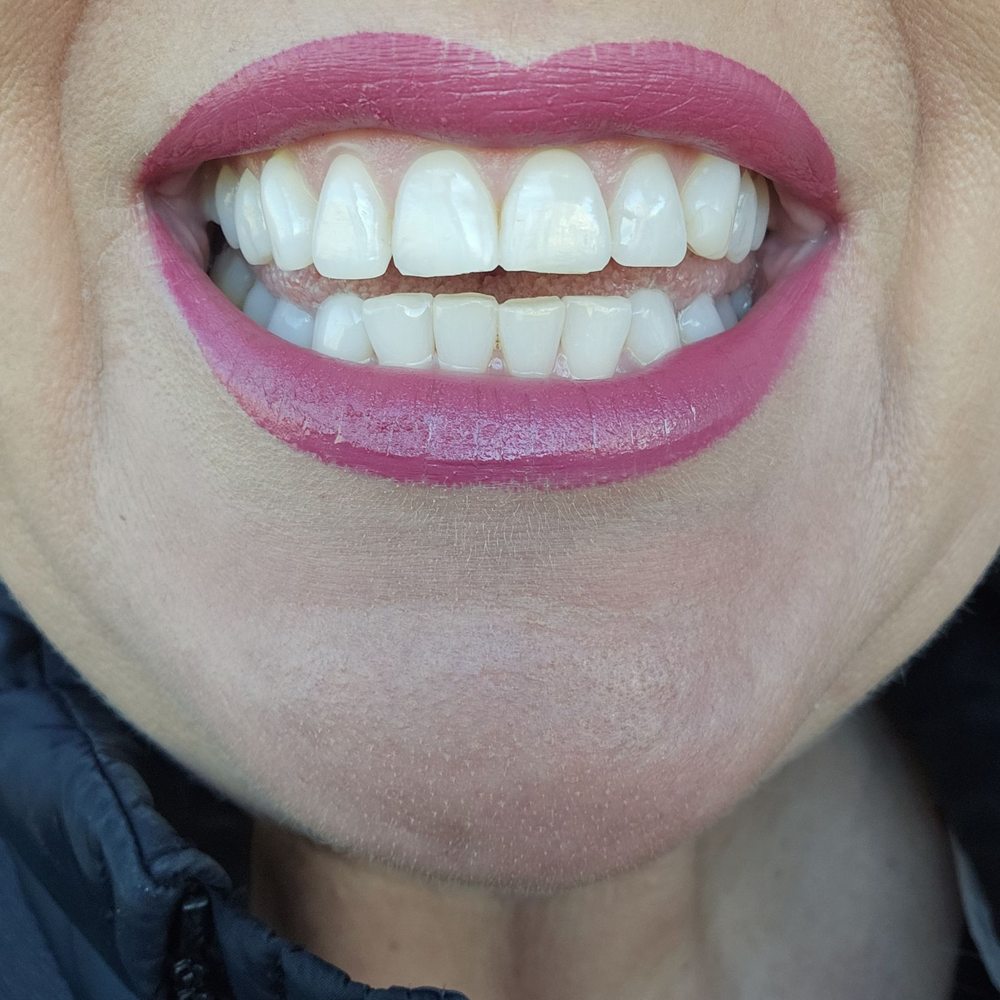 Rainbow Modern Dentistry - Chipped front tooth repair - General Dentistry Near Me - Las Vegas, Nevada Rainbow Modern Dentistry - Chipped front tooth repair - General Dentistry Near Me - Las Vegas, Nevada