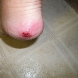 Chemical burn received during pedicure at Spice Nails