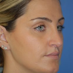Associates in Plastic Surgery - Post op rhinoplasty to reduce bump and refine tip