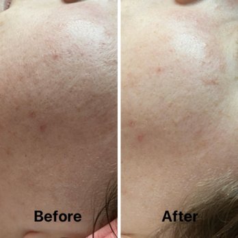 The Esthetics Bar - Opti Resurfacing Treatment! Skin is smooth, hydrated, draws out impurity's, brightens skin! - Skin Care Near Me - Clayton, North Carolina The Esthetics Bar - Opti Resurfacing Treatment! Skin is smooth, hydrated, draws out impurity's, brightens skin! - Skin Care Near Me - Clayton, North Carolina