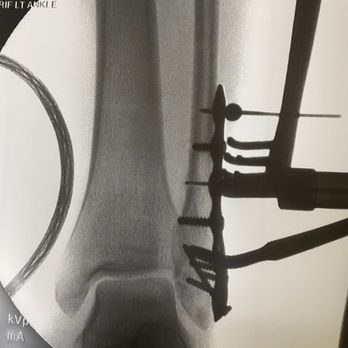 Mendez & Sanchez - Titanium plate and 9 screws to fix my ankle break - Personal Injury Law Near Me - Los Angeles, California