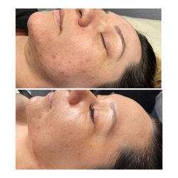 The Touch - Microneedling Before and After 3 sessions