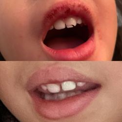 Newport Hills Pediatric Dentistry - Top: Before- Broken tooth w exposed nerve Bottom: After- Cap blended in very nicely and my daughter is no longer in pain.