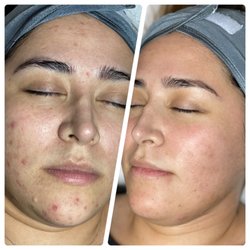 Acne bootcamp