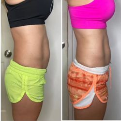 Diastasis recti repair with NeoSlim.