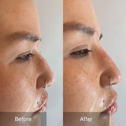Go Esthetics - Nose filler to instantly change your look!