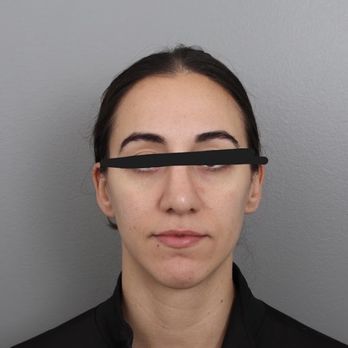Gold Coast Plastic Surgery - George Moynihan, M.D - Post op front view ( 1 year) - Skin Care Near Me - Chicago, Illinois