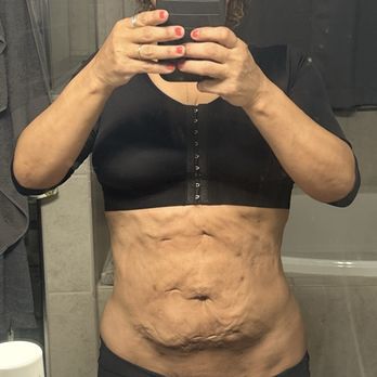 Robert Miles, DO - Bodze Plastic Surgery - This is the botch work he did and they want me to pay 1000 to fix what they did - Body Contouring Near Me - Tampa, Florida