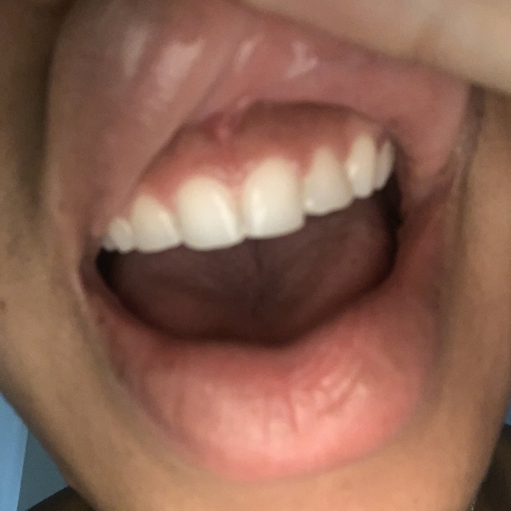 Robert D Argentieri, DDS - Here is a picture of my teeth, very crooked not straight at all. Very very disappointed... - Cosmetic Dentists Near Me - Springfield, Virginia