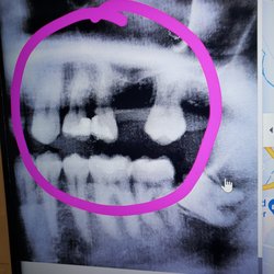 Cerio R Daniel, DMD - The upper molars are ruined.