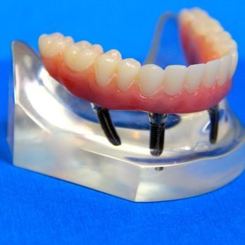 Southwest Denture Centre - All on 4 Implant System - Health & Medical Near Me - Edmonton, Alberta Southwest Denture Centre - All on 4 Implant System - Health & Medical Near Me - Edmonton, Alberta