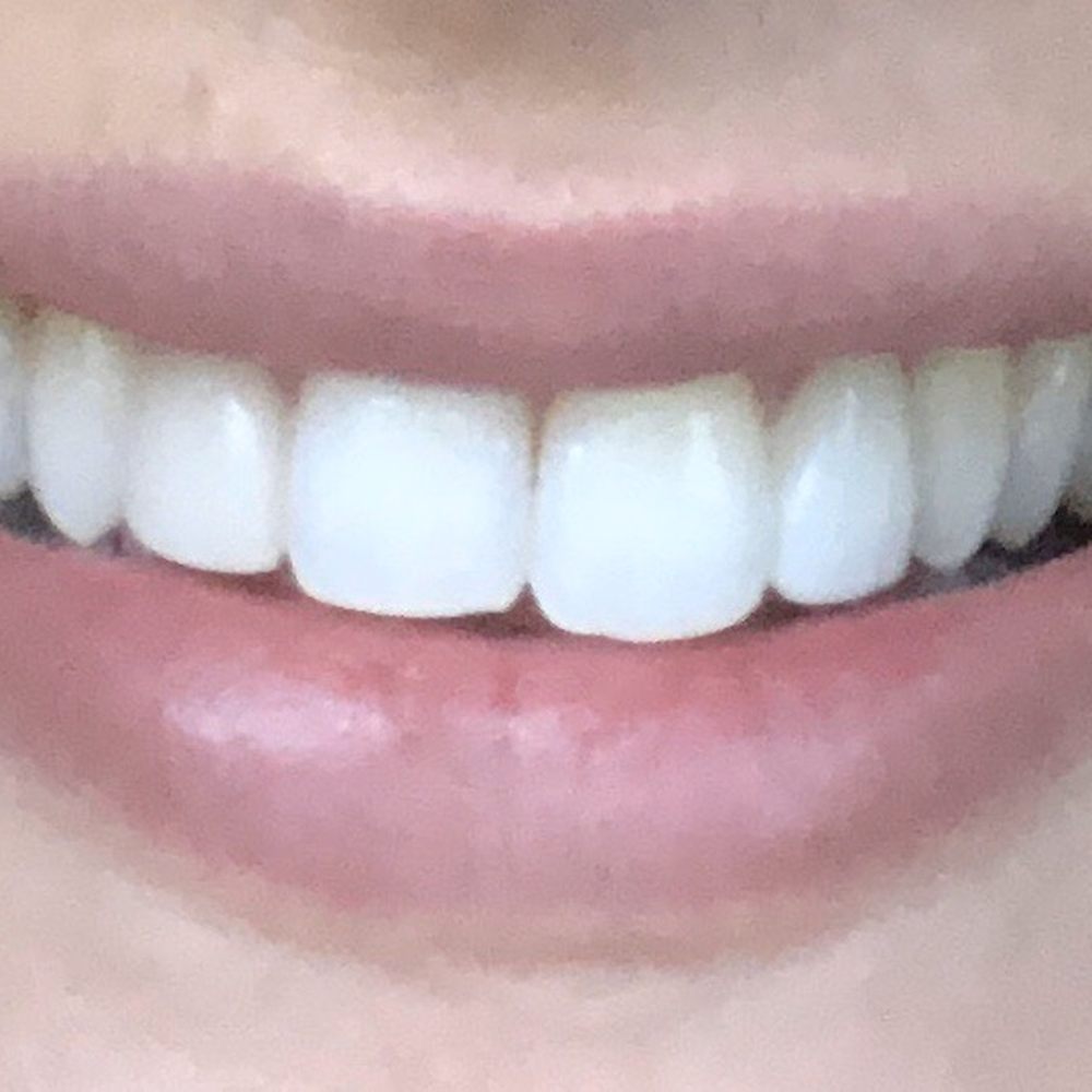 My Dentist In Miami - Crown fits perfectly - Cosmetic Dentists Near Me - Miami, Florida My Dentist In Miami - Crown fits perfectly - Cosmetic Dentists Near Me - Miami, Florida