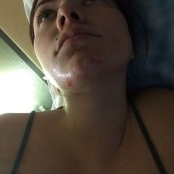 Nirvana - Day two of healing from my "chin" wax