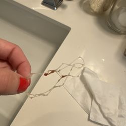 Fahad Sigari, MD, FACS - Stent that was supposed to dissolve that came out of my nose