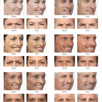 the biostation - Are you interested in removing or softening wrinkles? Botox, Dysport, & Xeomin work to decrease or eliminating contraction-induced wrinkles - Medical Spas Near Me - Delray Beach, Florida the biostation - Are you interested in removing or softening wrinkles? Botox, Dysport, & Xeomin work to decrease or eliminating contraction-induced wrinkles - Medical Spas Near Me - Delray Beach, Florida