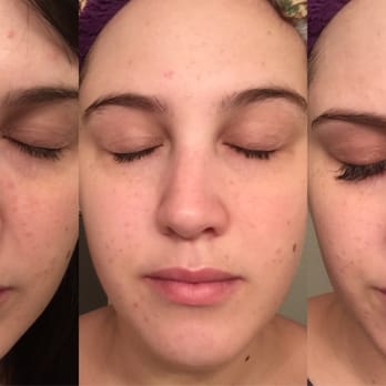 Making Faces - These photos are from day 1 pre treatment, and days 3 & 5 of using Georgia's en*core skin care line. - Skin Care Near Me - Newport Beach, California