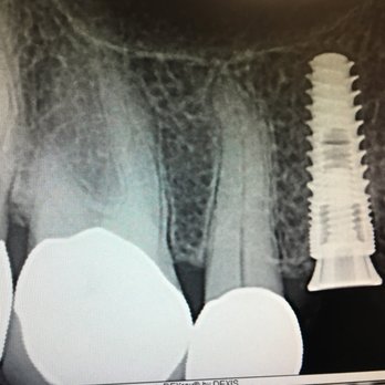 82nd Drive Dental - How an implant replaces the root of a tooth - General Dentistry Near Me - Clackamas, Oregon 82nd Drive Dental - How an implant replaces the root of a tooth - General Dentistry Near Me - Clackamas, Oregon