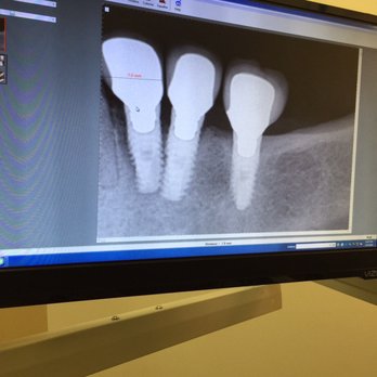 Martin N. Gorman, DDS - He placed the first one at an angle!!! - Cosmetic Dentists Near Me - Encino, California Martin N. Gorman, DDS - He placed the first one at an angle!!! - Cosmetic Dentists Near Me - Encino, California
