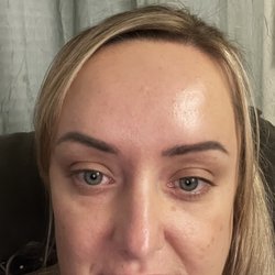 The Botox Lounge - After