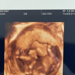 Baby View - 3d ultrasound 17 weeks