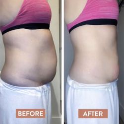 ReShapeMe Body Sculpting - Before and after