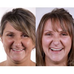 Davis Dental - Natural Result with Invisalign and porcelain veneers
