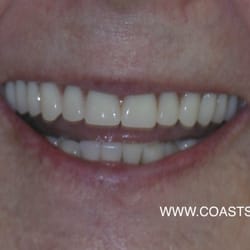 Orange Coast Dental Specialty - Upper denture