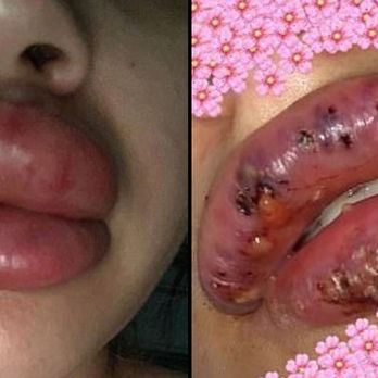 Karisma Beaute Effect - I got bad blisters/cold sores after getting the needless lip injections which made my lips look uneven. - Permanent Makeup Near Me - Atlanta, Georgia