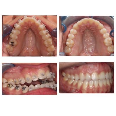 Get you Braces or Invisalign today ! - Elevate your smile to new heights at Vivian Lee Orthodontics, strategically situated in the heart of Arcadia, CA, and dedicated to serving the surrounding areas. Time is of the essence, and our team of committed specialists is ready to usher you into an urgent and professional orthodontic experience, specializing in both braces and Invisalign. Whether you aspire to the precision of traditional braces or the discreet charm of Invisalign, the opportunity for a confident, straightened smile is at your doorstep. Seize this moment – step into our cutting-edge facility today for a comprehensive consultation, meticulously crafted treatment plans, and expert insights. Embrace the urgency of transforming your smile and schedule your appointment now. Vivian Lee Orthodontics is your trusted ally on the journey to orthodontic excellence, providing not just treatment but a pathway to a lifetime of confidence and impeccable oral health. Act swiftly – your radiant smile is just a visit away!