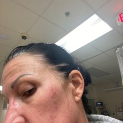 South Texas Dermatology - Blistering and scabbing on my face after chemical peel