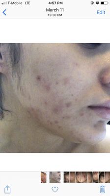 Acne Clinic Nyc 98 Photos 51 Reviews Skin Care 108 W 39th St Midtown West New York Ny United States Phone Number Yelp