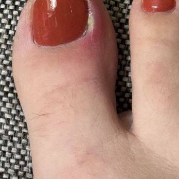 Voncii Nail Bar - Infected toe from a pedicure. - Nail Salons Near Me - O'Fallon, Missouri Voncii Nail Bar - Infected toe from a pedicure. - Nail Salons Near Me - O'Fallon, Missouri
