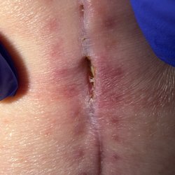 Stephen Esses, MD - Dr Esses left me with an open surgical wound after performing a Laminectomy 7 weeks ago. No concerns whatsoever Said this was "fine".