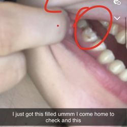 Dentistry @ Montreal Square - Here is another tooth that they 'stand by' their work as the dentist said, both of these teeth cause me so much pain