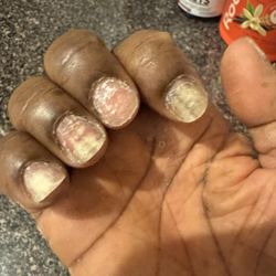 Sweet Nails - My right hand with rash in palm and damaged nail plates, nails turning yellow and white. Rash around cuticles.