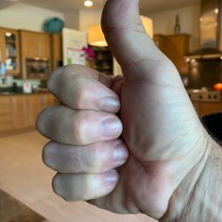 Freedman Eric, MD - This hand was crushed with compound fractures and it's back to 90%+ function. I'm really happy with the care and results!