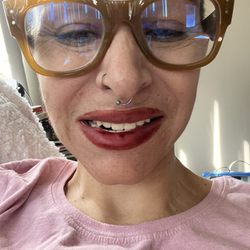 Temp prosthetic all on four dr kilander